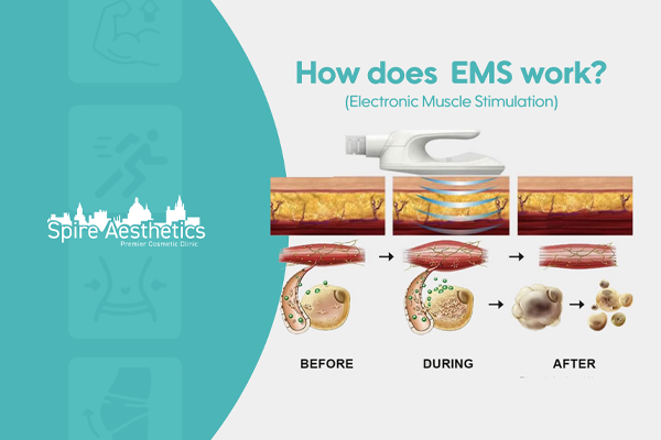 EMS treatment for post pregnancy weight loss treatment Wentworth