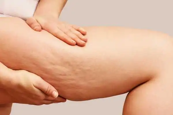 Image of woman showing leg with cellulite Wentworth