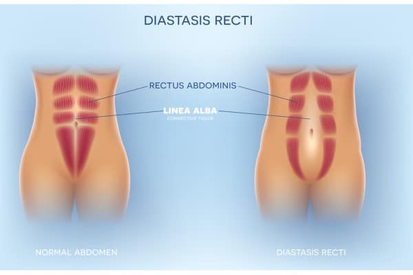 What Non-Surgical Options Are Available for Diastasis Recti Wentworth?