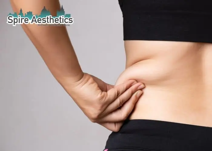 Image of woman pinching fat on their hips Wentworth. Fat Freezing treatment