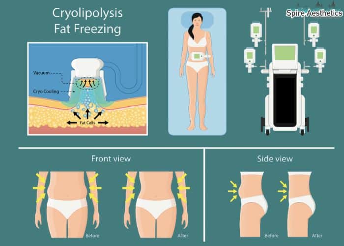 Image of diet and fat freezing combined for best results for Spire Aesthetics Wentworth