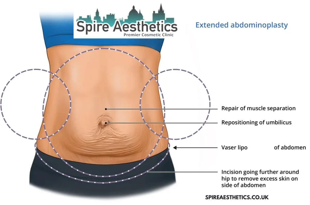 Understanding Loose Skin After Gastric Band Wentworth Surgery and HIFU Treatment