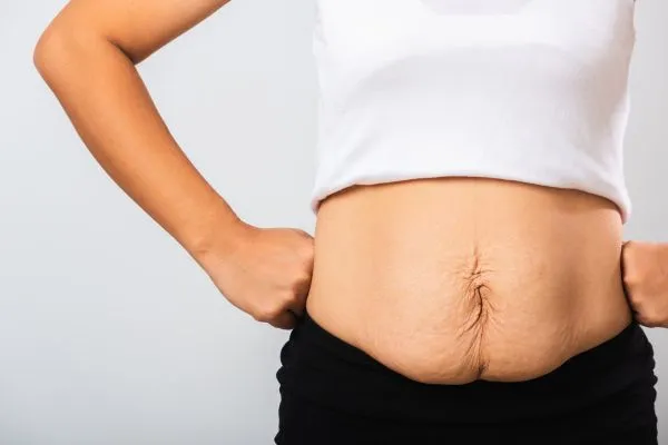 Image of a woman's stomach after weight loss with sagging skin following a gastric band Wentworth