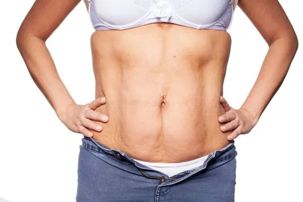 sagging skin on woman's stomach after weight loss injections Wentworth