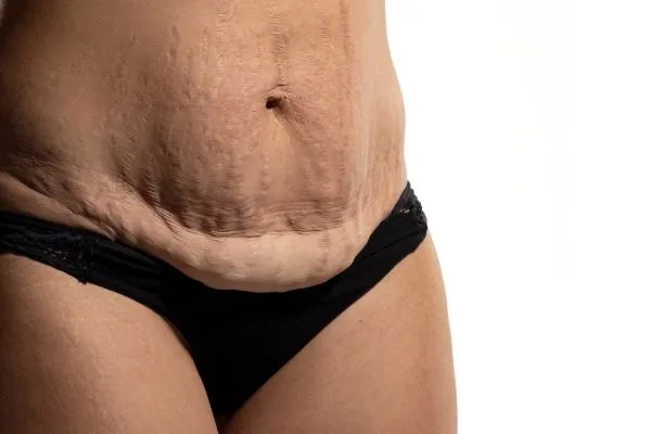 Image of womans stomach after weight loss injections Wentworth showing saggy skin