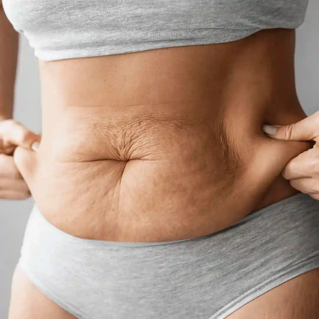 Is It Normal to Have Loose Skin After Pregnancy Wentworth?