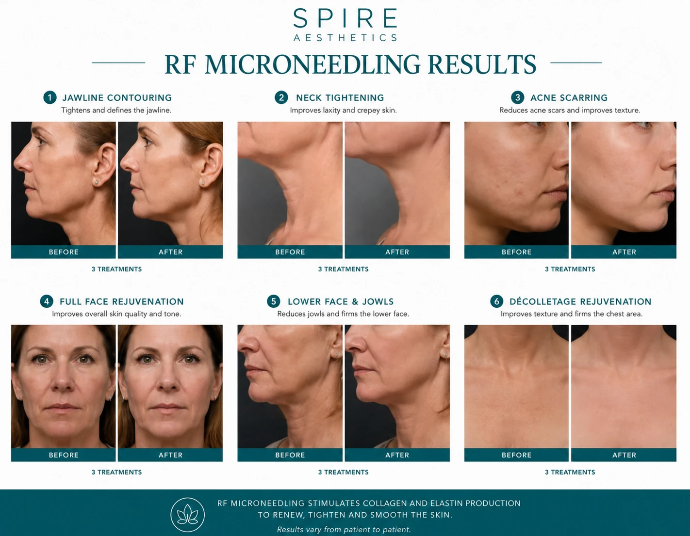 RF Microneedling Skin tightening Wentworth results