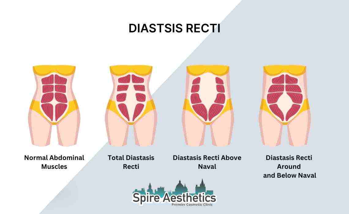 Is Non-Surgical Diastasis Recti Treatment Right for You? Common Concerns Answered Wentworth